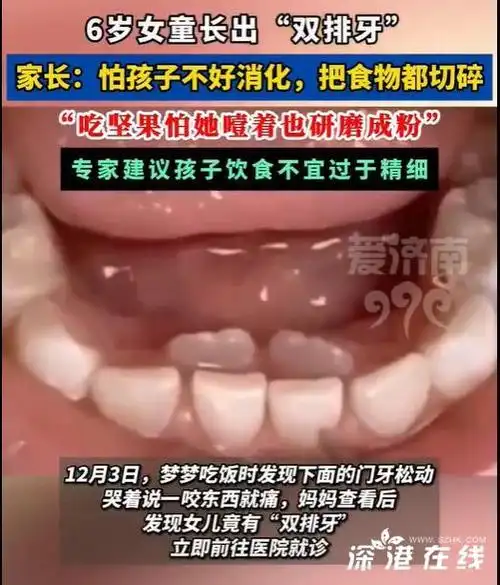 6岁女童长出双排牙是因为吃得太精细吗