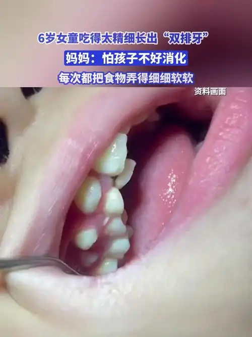 6岁女童长出双排牙是因为吃得太精细吗
